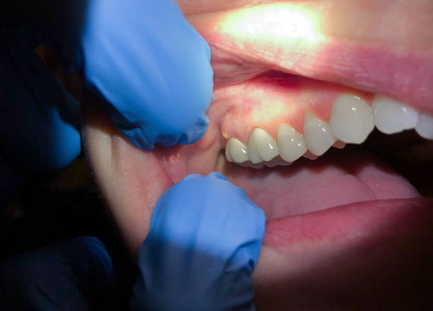 Best Emergency Treatment for Dental Infections or Abscesses in El Cerrito, CA